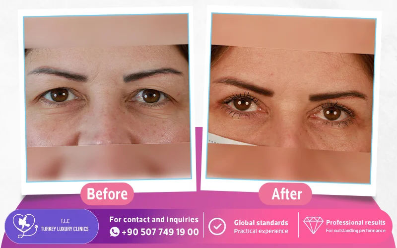 Upper Eyelid Surgery Before and After Photos