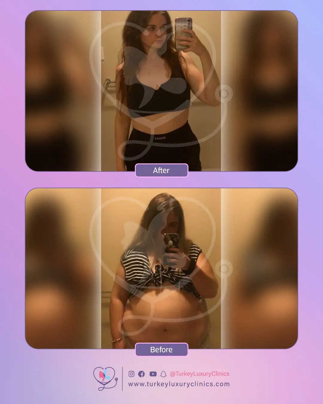 Bypass Turquie : Prix tout inclus - Chirurgien expert & suivi