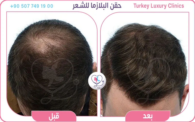 حقن البلازما للشعر قبل وبعد