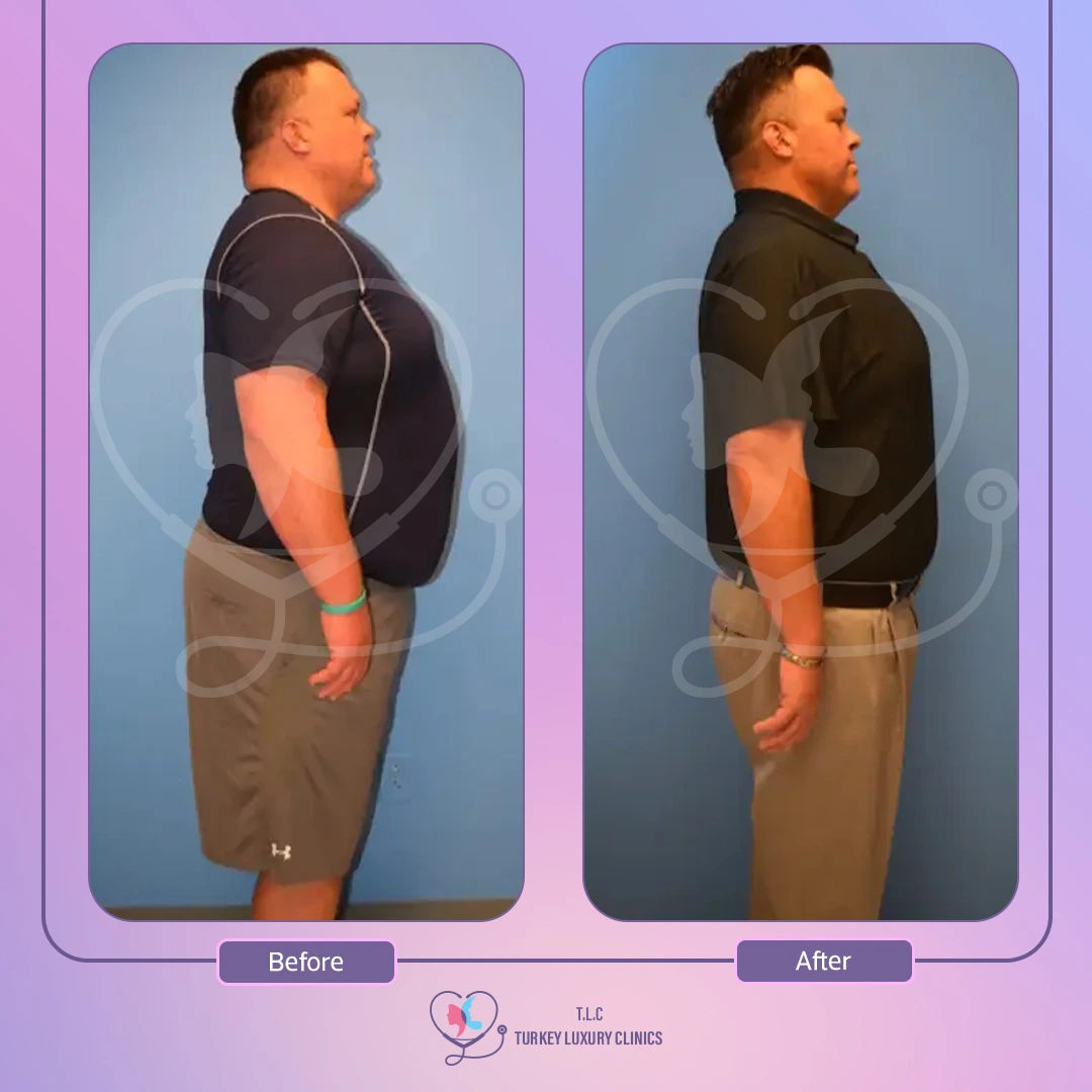 sleeve laparoscopique avant après - cas n° 3