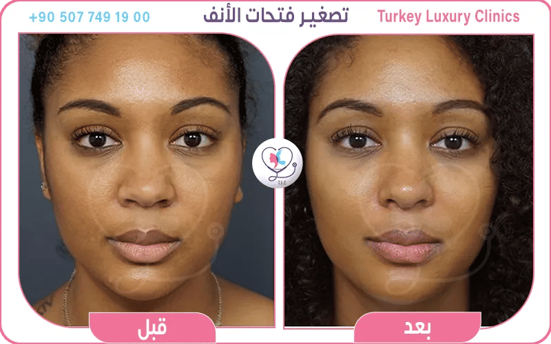 تصغير فتحات الأنف