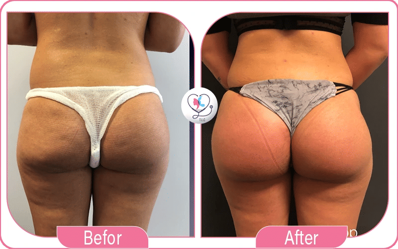 Lipofilling fessier avant / après-4