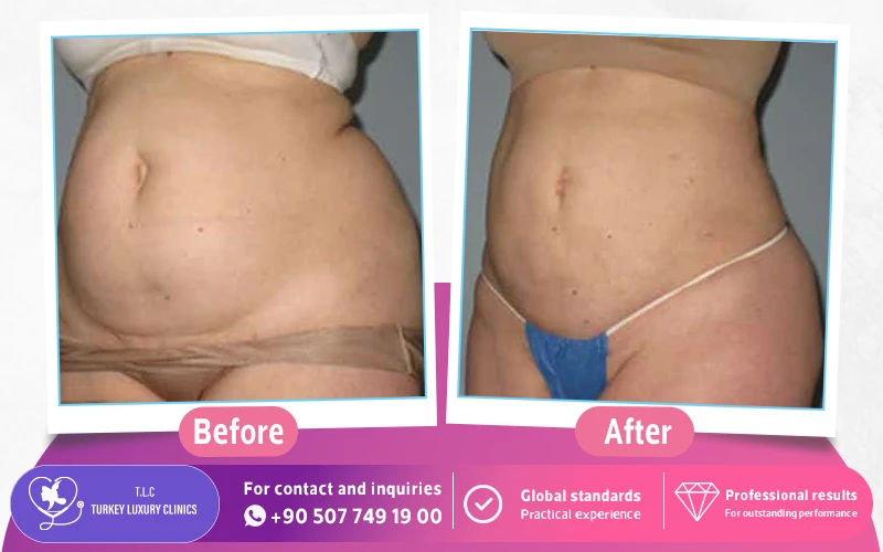 Laser Liposuction Before and After Photos