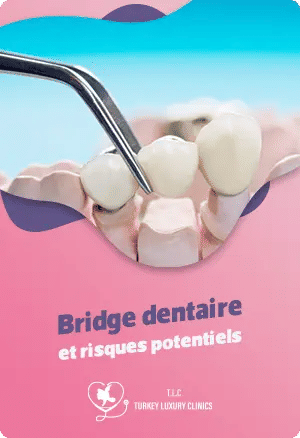 Bridge dentaire et risques potentiels pour les dents adjacentes