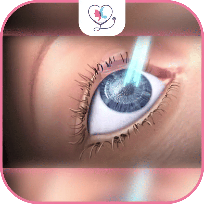 تكلفة عملية الليزك في مختلف الدول: دراسة ومقارنة