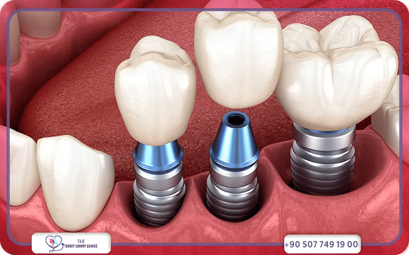 Qu’est-ce qu’un implant dentaire complet ?