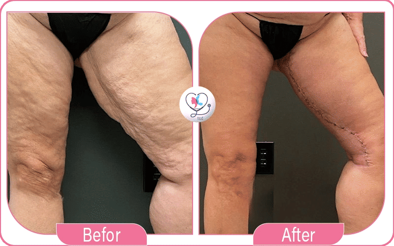 9. Inner Thighs: Lipo 360 Contouring