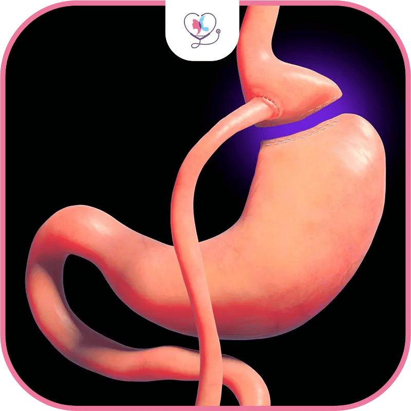 ما هي عملية تحويل مسار المعدة المصغر بالمنظار؟