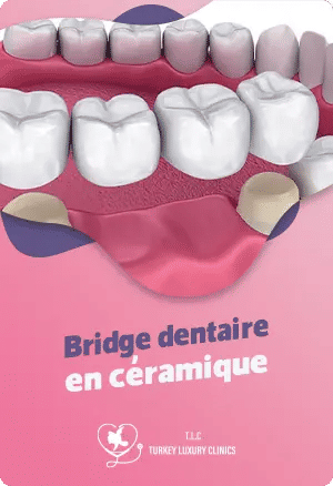 Bridge dentaire en céramique : esthétique et durabilité