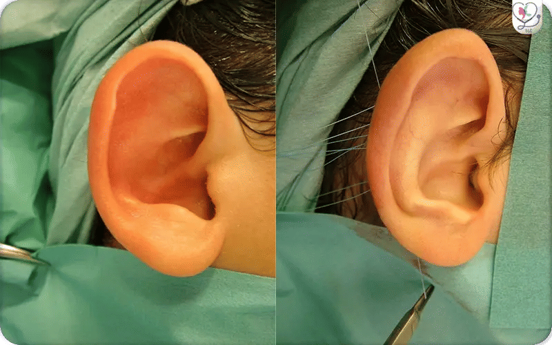 Incisionless Otoplasty Turkey
