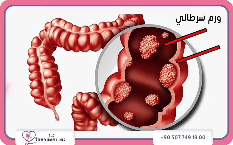 أعراض سرطان الأمعاء أعراض سرطان الأمعاء