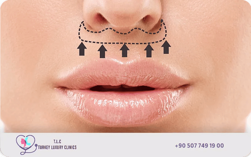 رفع الشفة المركزية Central Lip Lift
