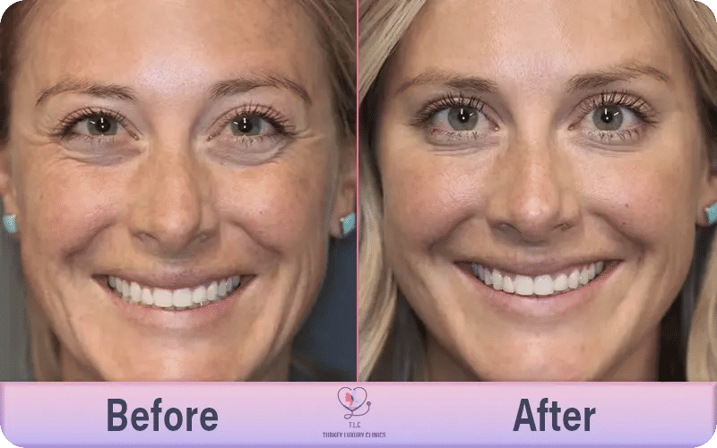 نسبة نجاح حقن البوتوكس في تركيا