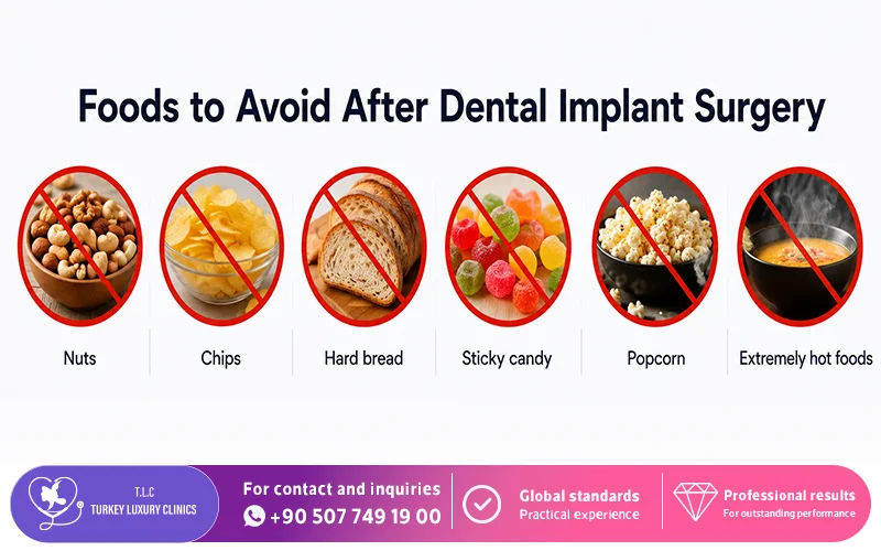 Foods to Avoid After Dental Implant Surgery Foods to Avoid After Dental Implant Surgery
