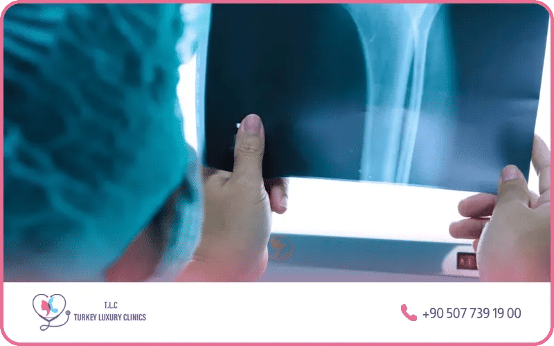 تشخيص سرطان العظام