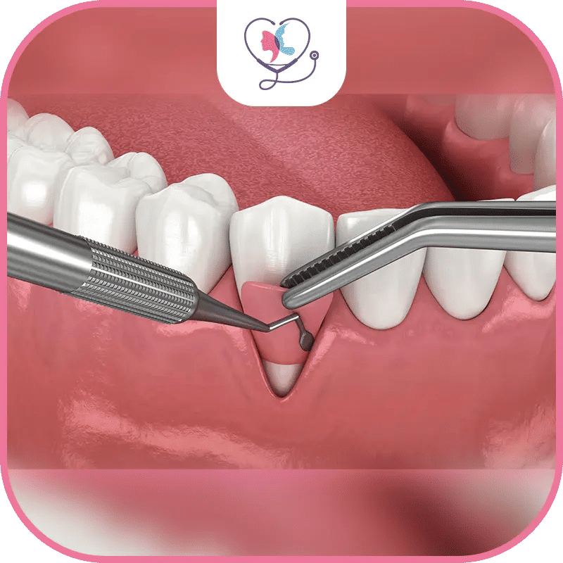 جراحة اللثة في تركيا