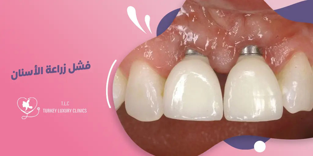 فشل زراعة الأسنان