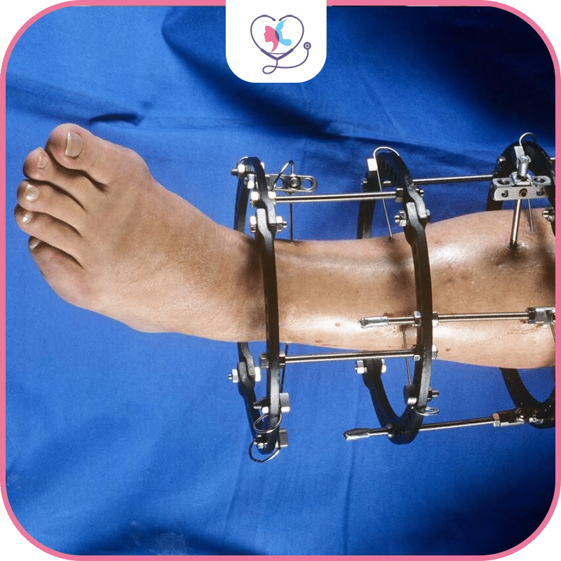 تطويل العظام باستخدام جهاز اليزاروف