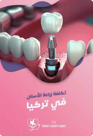 تكلفة زراعة الأسنان في تركياfeatured image