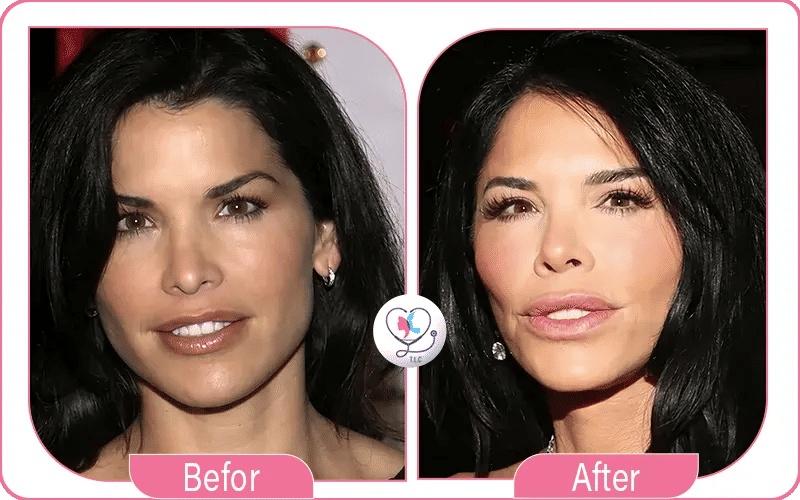 Celebrity Lauren Sánchez facial transformation showing results of plastic surgery.