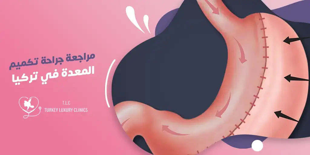 جراحة تصحيح تكميم المعدة