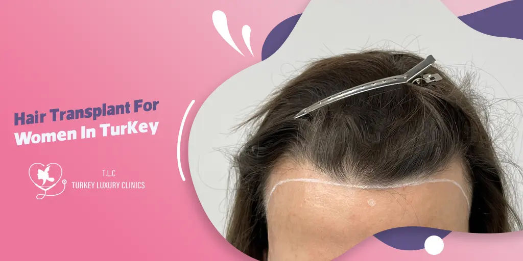 Hair Transplant For Women In Turkey