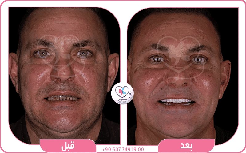 عمليات تجميل الأسنان في سوريا