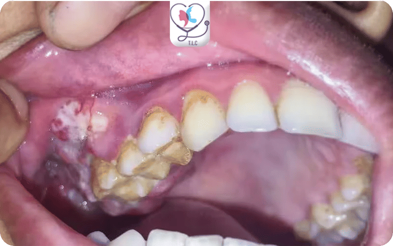 ما هو سرطان اللثة؟