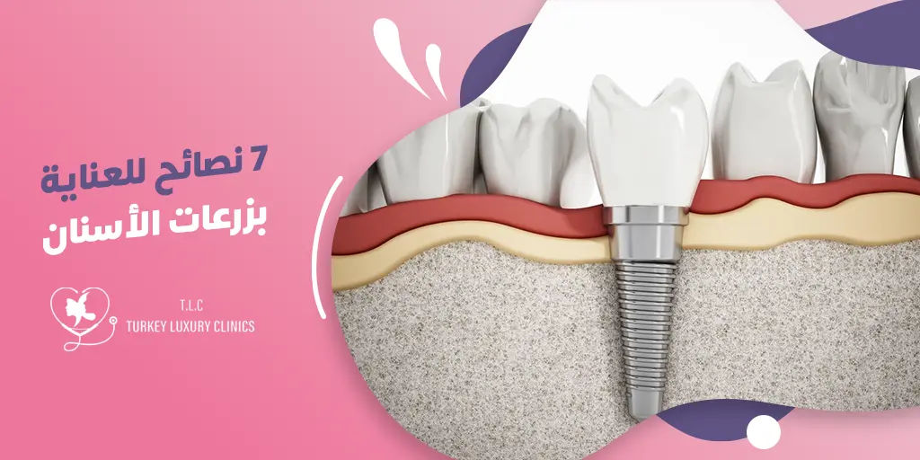 7 تعليمات بعد زراعة الأسنان