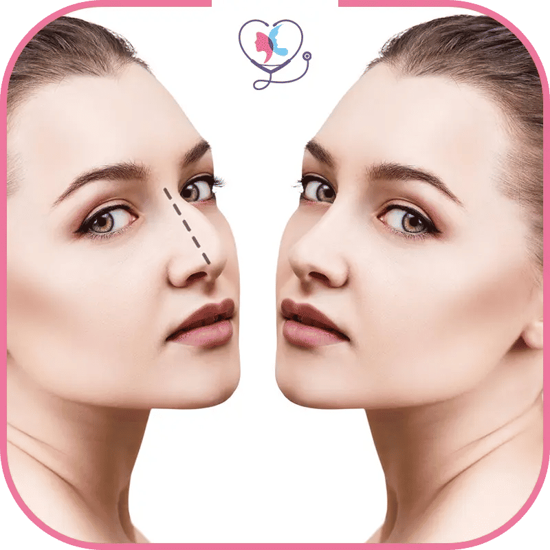 تجربتي مع عملية تجميل الانف