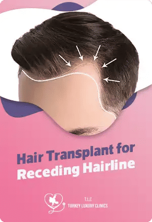 Hair Transplant for Receding Hairline: Restore Your Hair Naturally