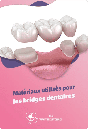 Matériaux utilisés pour les bridges dentairesfeatured image