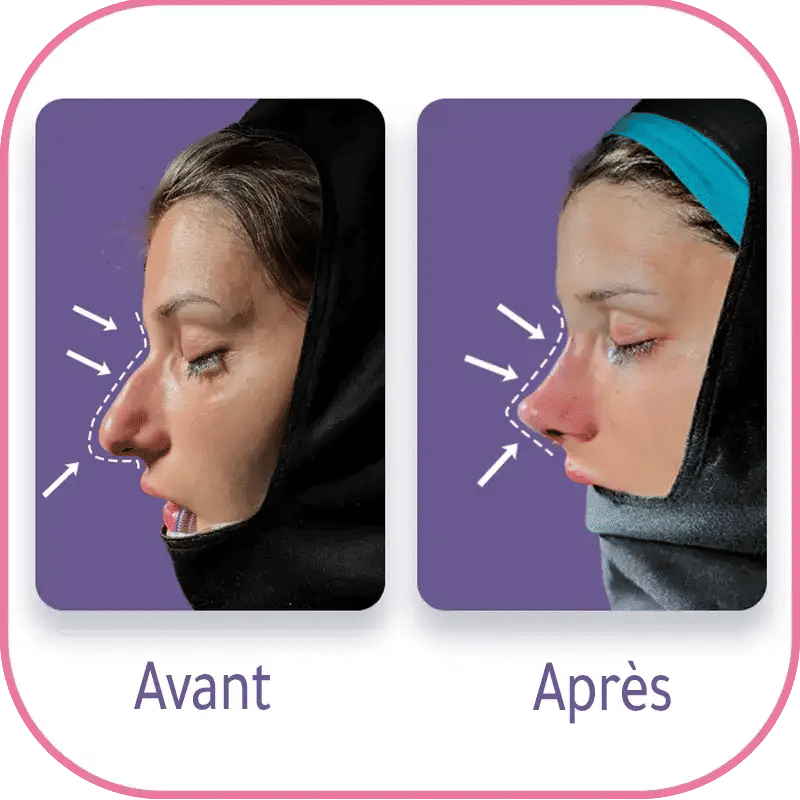 Quelles sont les indications esthétiques de la rhinoplastie médicale ?