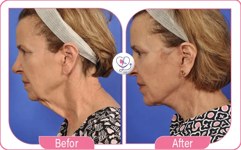Turkey Neck Lift Before and After Photos