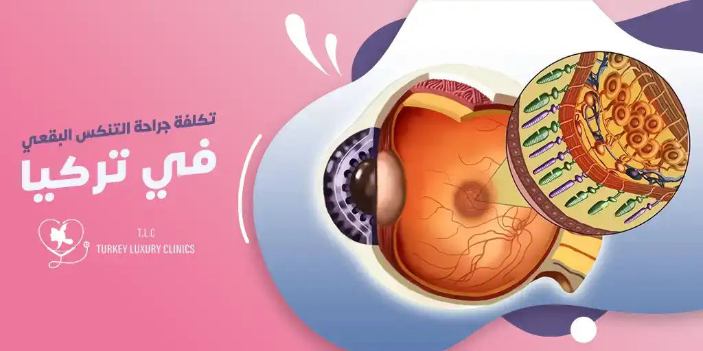 تكلفة جراحة التنكس البقعي في تركيا