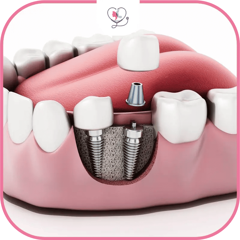 Benefits of Dental Implants for Seniors
