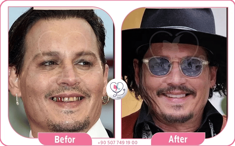 Johnny Depp new teeth 2024 – bright symmetrical smile after full mouth rehabilitation with veneers and crowns