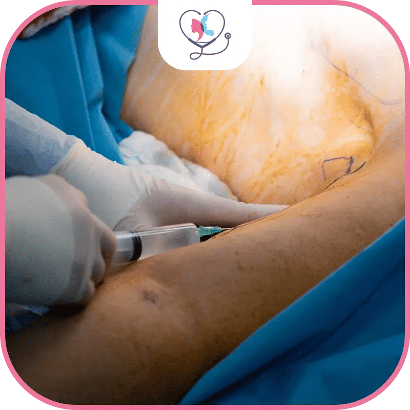 عملية شد الذراعين في تركيا