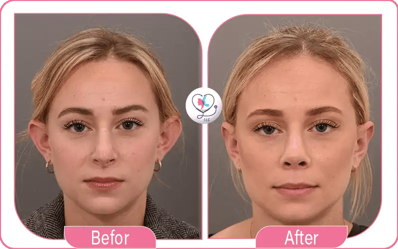 Before and After Otoplasty