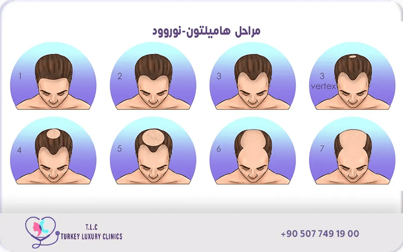 مقياس هاميلتون-نوروو