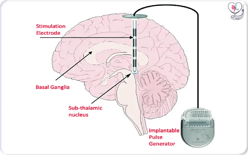 4. Pulse‑Generator Implantation 2