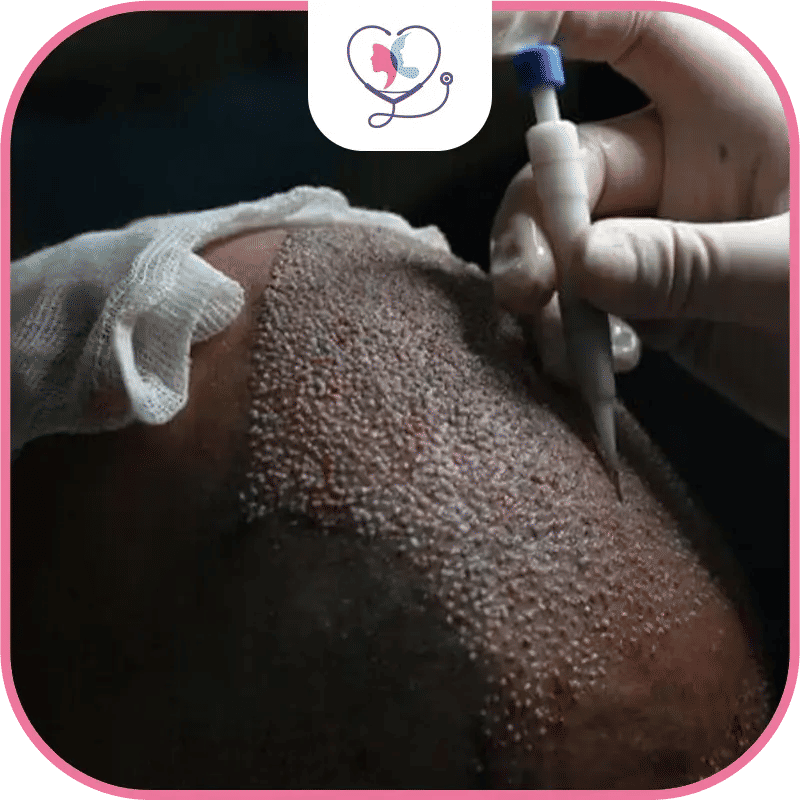 DHI Hair Transplant Turkey 2026: Prices, Results & What to Expect  image 1772043687960