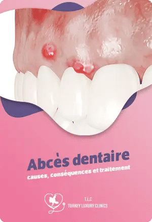 Abcès dentaire : causes, conséquences et traitement