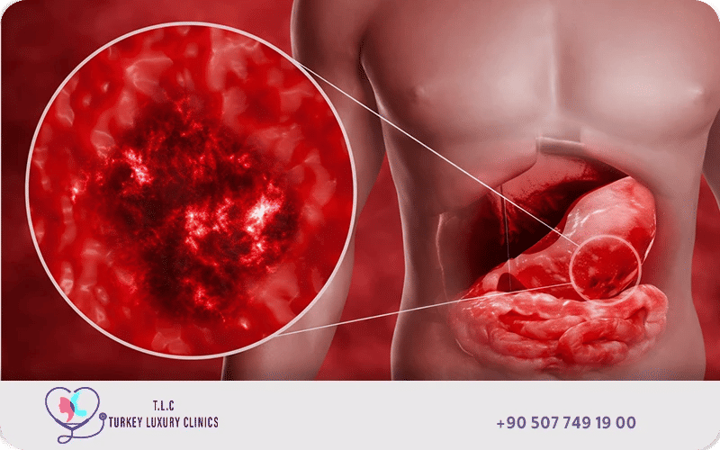 ما هو سرطان المعدة؟