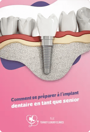 Comment se préparer à l'implant dentaire en tant que senior