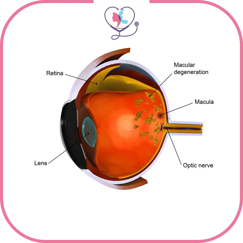تكلفة جراحة التنكس البقعي في تركيا