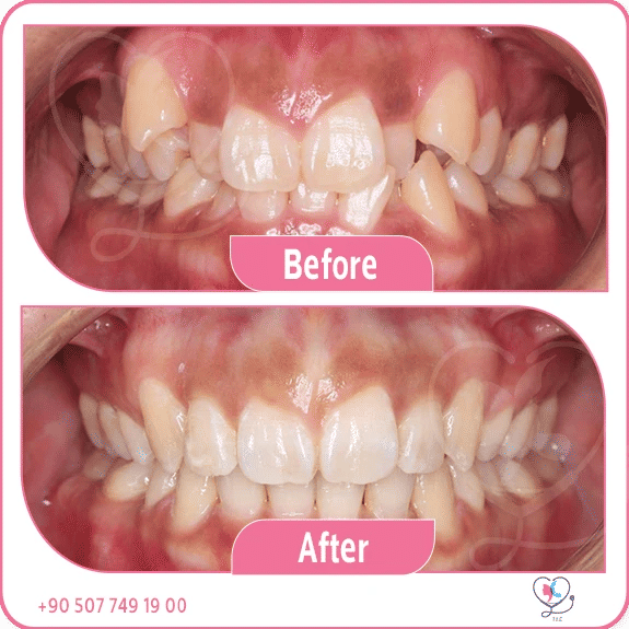 Advanced dental technology Turkey – step-by-step guide to getting dental treatment at Turkey Luxury Clinics Istanbul