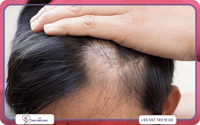 علاج الثعلبة في تركيا مع أطباء تركيا لاكشري كلينك