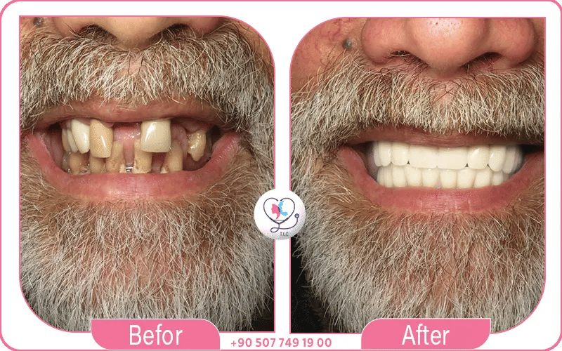 implant dentaire molaire avant après