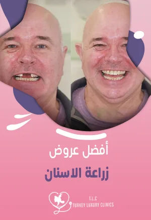 عروض زراعة الاسنان: تركيا والسعودية ودول أخرى مقارنة 2026